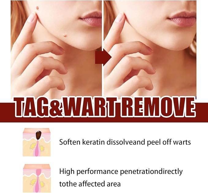 Tags and Moles Remover
