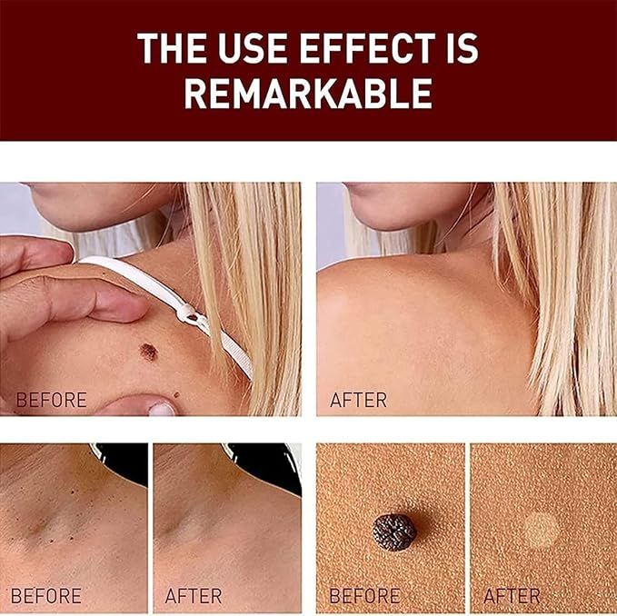 Tags and Moles Remover